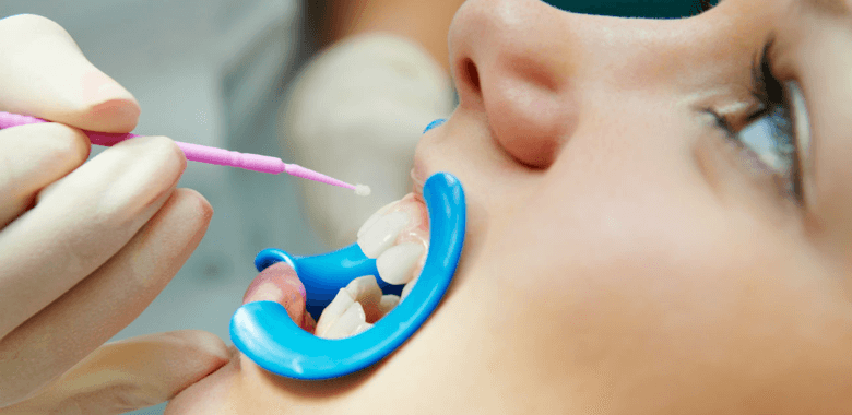 Фторирование и ремотерапия зубов