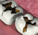 В случае поражения зубов кариесом