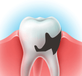 Разрушенность коронковой части зуба ниже уровня десны