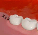 При удалении непрорезавшегося зуба накладываются швы