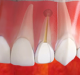 Резекция проводится на зубах, прошедших лечение каналов