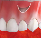 Около причинного зуба делается аккуратный разрез десны